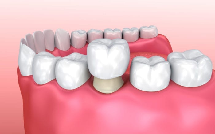 Dental Crown Treatment in Hampstead, North Carolina