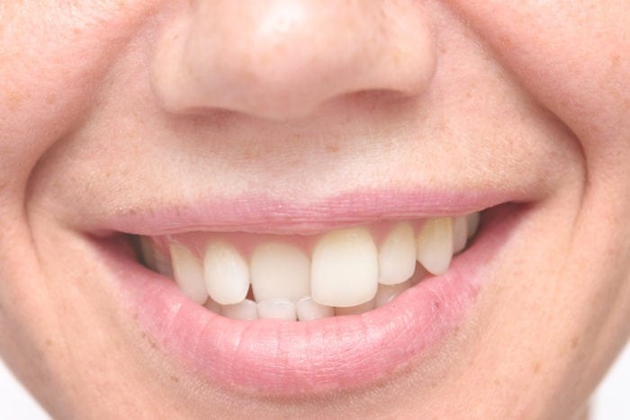 treat crooked teeth in hampstead, north carolina