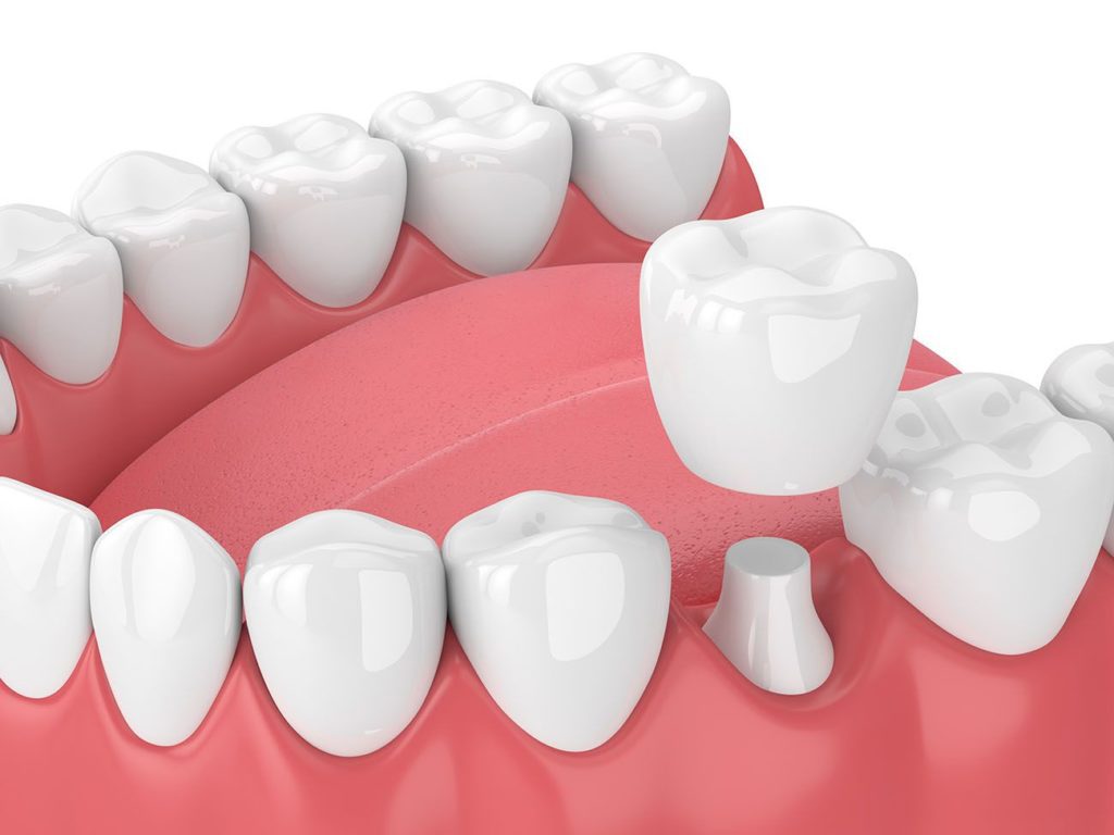 dental crown procedure in Hampstead North Carolina