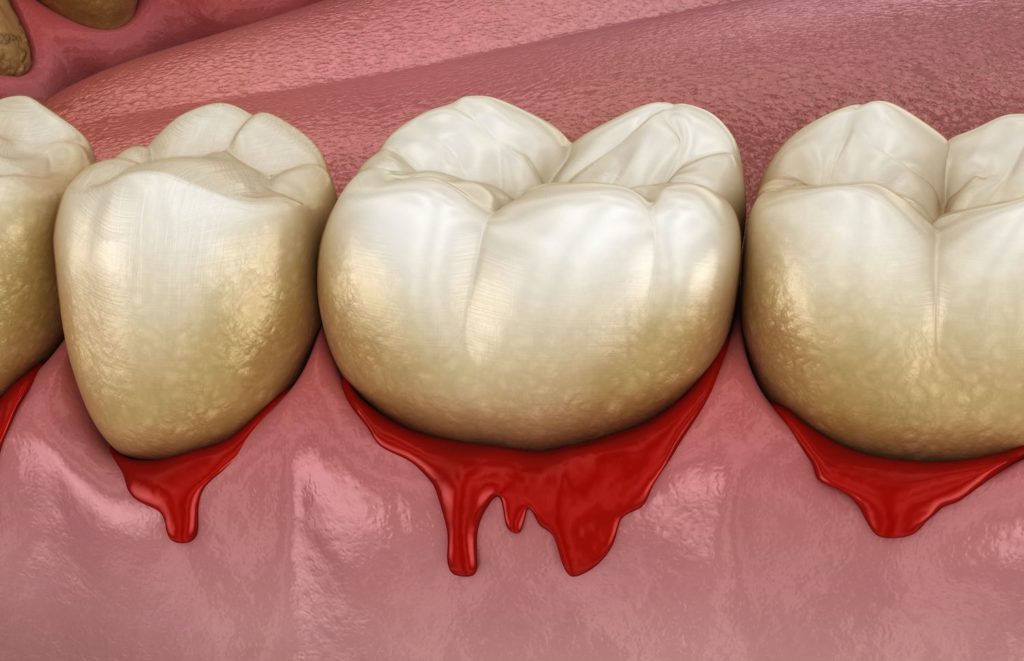 periodontal disease in Hampstead North Carolina
