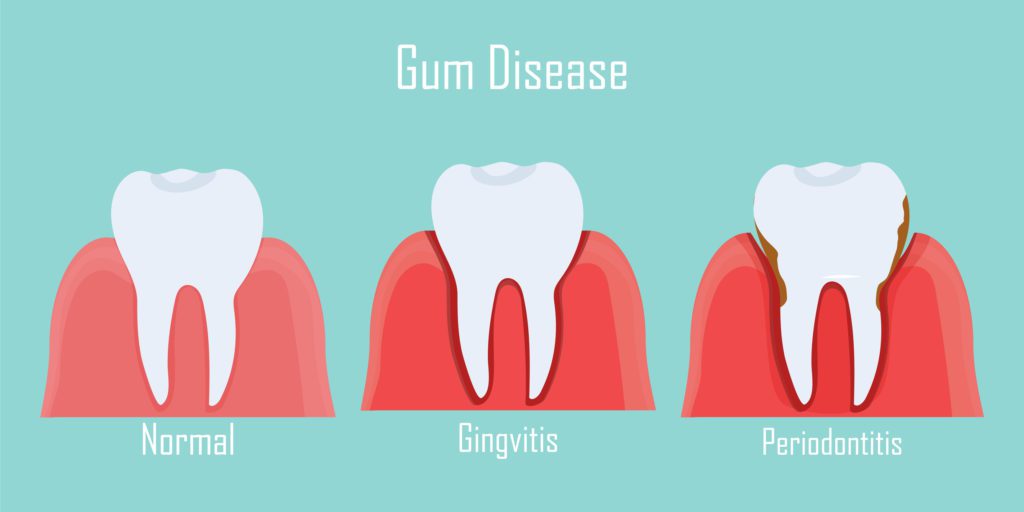 treatment for gum disease in hampstead nc