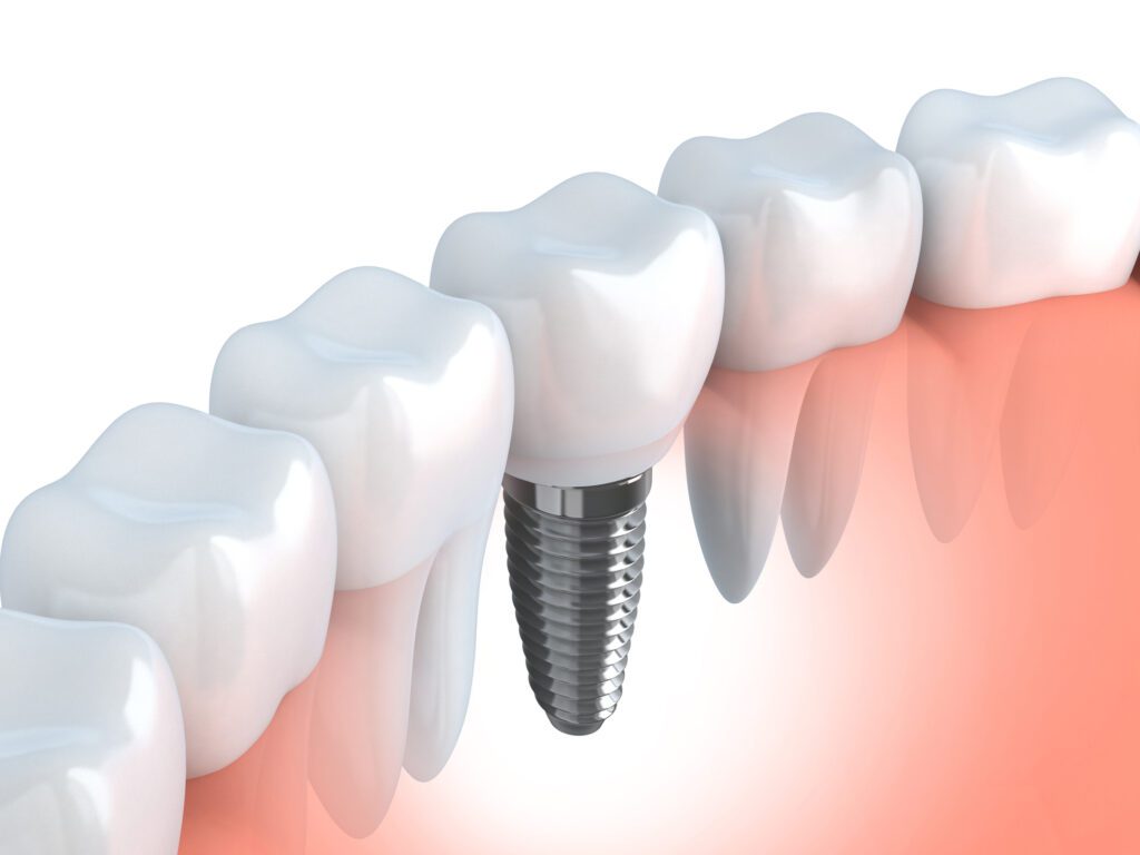 dental implants faqs in Hampstead, NC