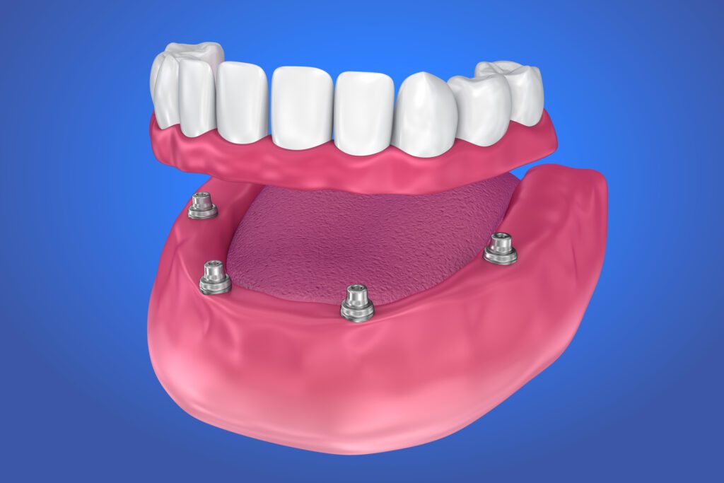 denture implants in Hampstead, NC