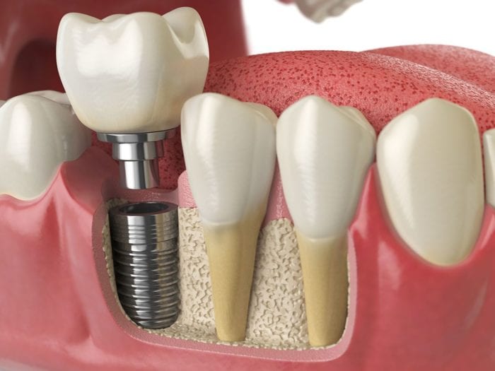 What are Dental Implants? Seaside Family and Cosmetic Dentistry provides dental implants in Hampstead, NC